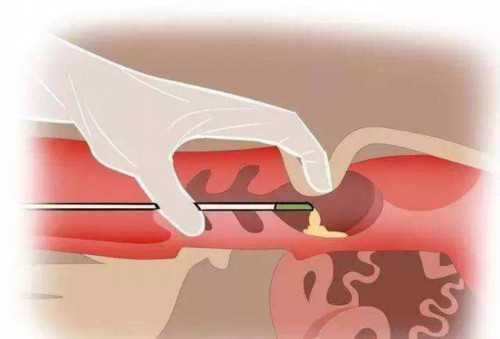 早孕先兆流产如何面对？医生建议的孕早期安全流产方式是什么？